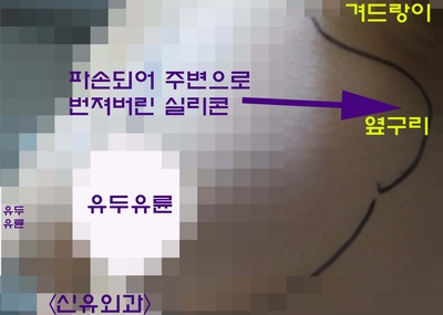 피막외파손 보형물 실리콘이 겨드랑이림프절로 퍼진 경우, 가슴성형재수술