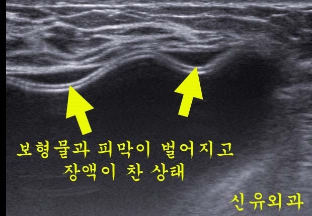 처진가슴 거상술(재수술)+보형물교체성형+부유방제거 : 부분마취로 전부 다