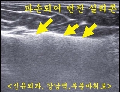 파손된 가슴보형물(옛날실리콘) 제거하며 처진가슴의 유방거상술, 부분마취로 석회화된 피막까지 제거