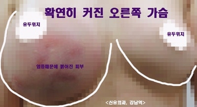 가슴보형물 염증으로 고름(농양)도 같이 제거했던 분 (마치 가슴필러부작용처럼)