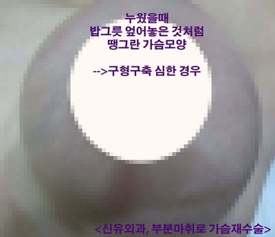 구형구축 가슴성형재수술을 부분마취로 피막을 싹 다 걷어냄. 피 안 나게 보형물제거교체, 강남역신유외과에서.
