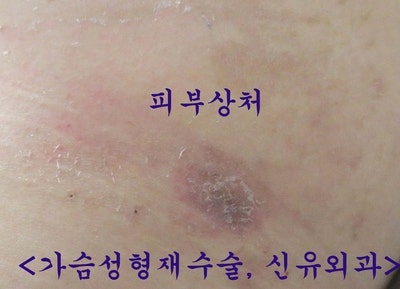염증 생긴 가슴보형물 제거 교체: 피막청소에 성공해서 기존 방을 유지한 분.