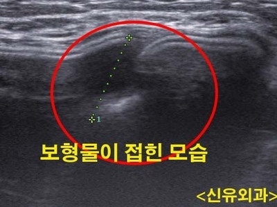 가슴성형재수술 : 구형구축된 피막을 제거하는데 이중피막, 삼중피막으로 되어 있던 분 (부분마취로)