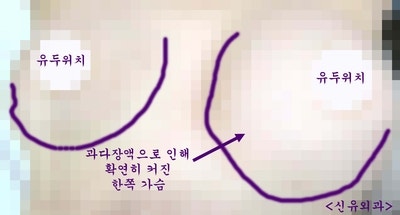 구형구축된 이중피막을 제거한 가슴성형재수술 : 과다장액을 해결