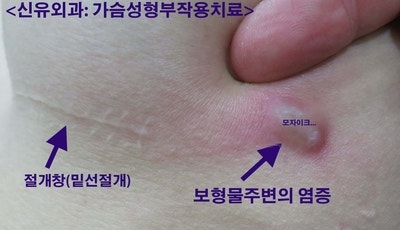 가슴수술 몇 년 후 생긴 염증으로 가슴성형재수술 보형물제거