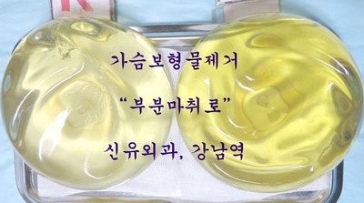 가슴보형물제거 부분마취로 간단히 하신 연예인 분 : 장액제거로 고생하심