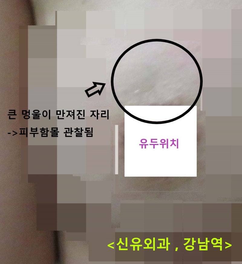 〔신유외과〕 가슴보형물확대술 후 오랜만에 받은 유방검진 -> 유방암 진단된 경우