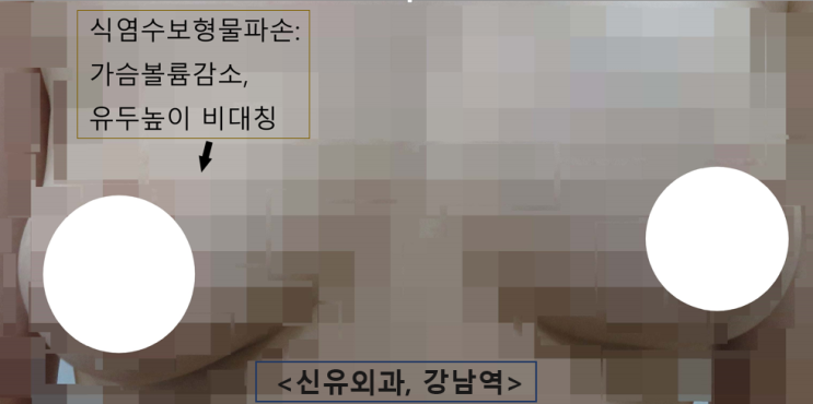 〔신유외과〕 식염수보형물파손-보형물교체 : 부분마취로.