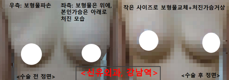 〔신유외과〕 가슴보형물파손, 처진가슴: 가슴보형물교체하고, 처진가슴교정 가슴거상하신 분
