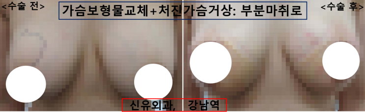 〔신유외과〕 가슴보형물교체, 처진가슴거상을 동시에: 부분마취, 반달절개로.