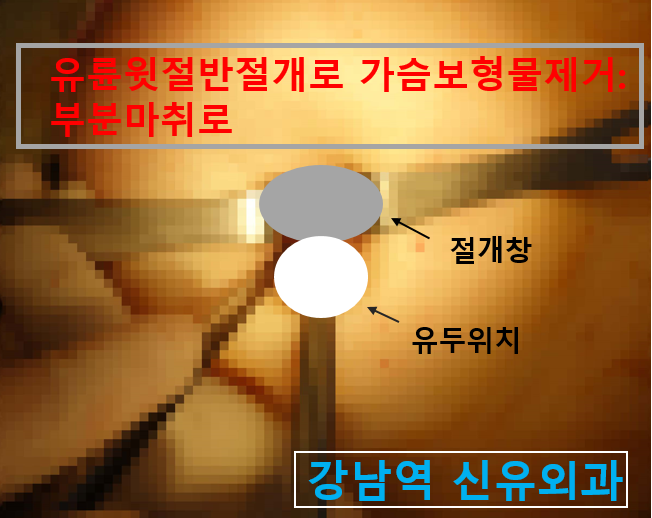 〔신유외과〕 물방울보형물교체(비유착으로 회전),이중피막제거와 과다장액제거: 모두 부분마취로