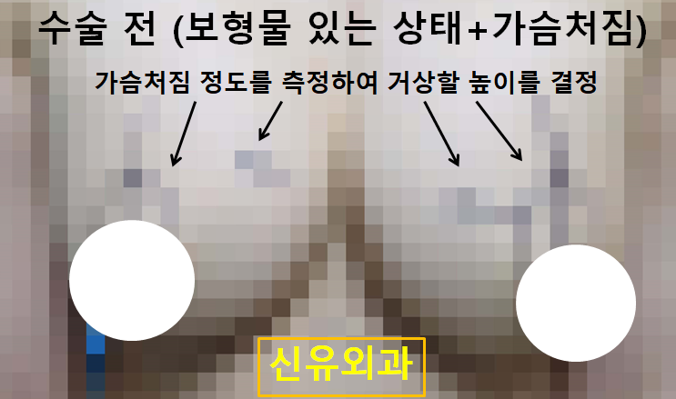〔신유외과〕 가슴보형물제거 + 처진가슴거상: 부분마취, 반달절개로