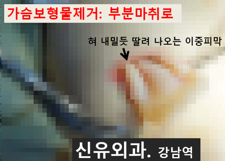 〔신유외과〕 가슴보형물제거: 이중피막제거, 장액제거도 같이. 부분마취로.