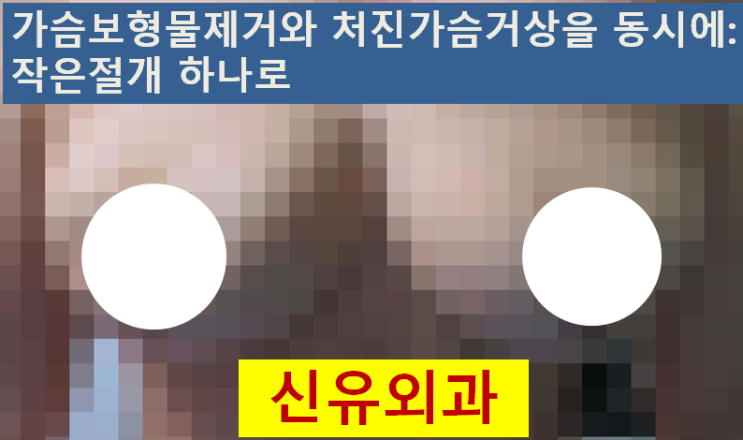 〔신유외과〕 옛날실리콘보형물제거 + 처진가슴거상 (보형물파손, 양쪽)