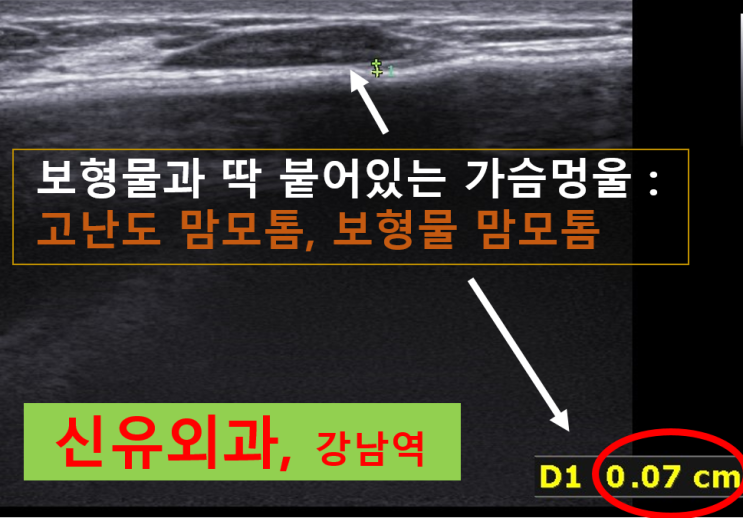 〔신유외과〕 가슴보형물수술후 맘모톰, 보형물있는 맘모톰 : 보형물파손 없이 안전하게.