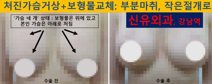 〔신유외과〕 처진가슴거상+가슴보형물제거교체: 부분마취, 작은절개(반달절개)로