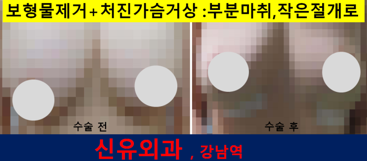 〔신유외과〕 처진가슴거상+가슴보형물제거를 동시에: 부분마취, 작은절개(유륜반달절개)로
