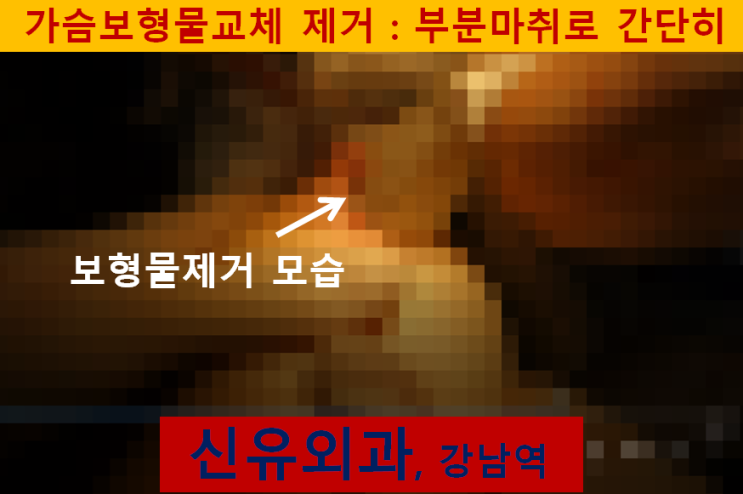 〔신유외과〕 가슴보형물교체(물방울보형물 비유착 회전),이중피막제거,장액제거: 부분마취로
