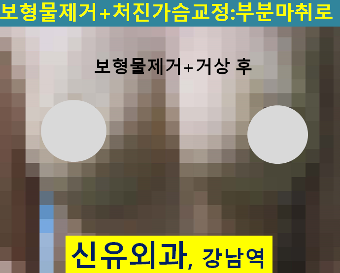 〔신유외과〕 가슴보형물제거하며 처진가슴거상술도 같이: 작은 절개 하나로, 부분마취로