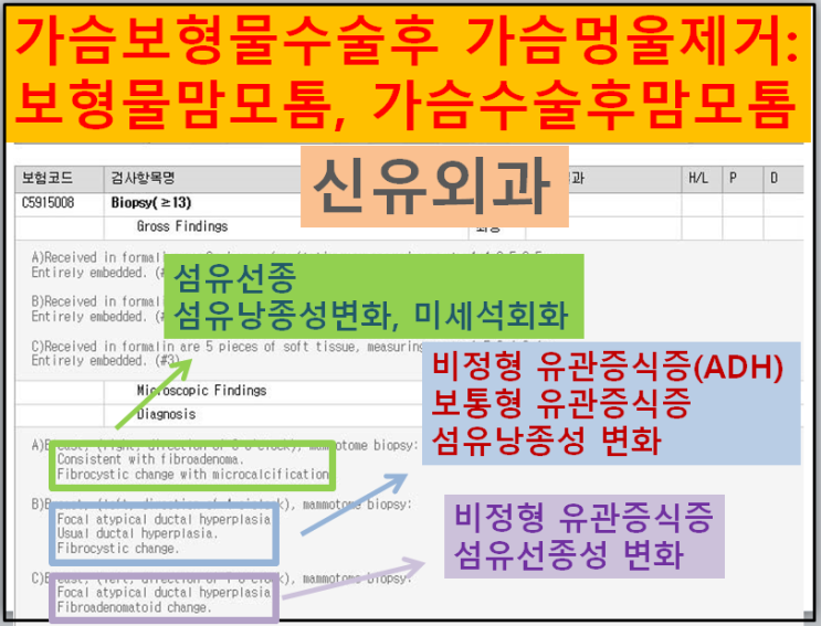 〔신유외과〕 가슴보형물파손 없이 맘모톰하기: 보형물맘모톰, 고난도맘모톰, 가슴멍울생검