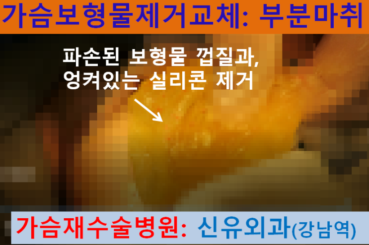 〔신유외과〕 파손된 가슴보형물제거교체+ 가슴멍울맘모톰: 부분마취로 안전하게