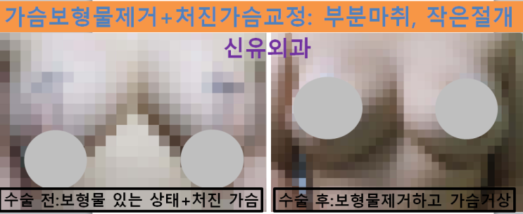 〔신유외과〕 구형구축 생긴 보형물제거, 피막제거하면서 중심보강방식으로 처진가슴거상 (반달절개, 부분마취로)
