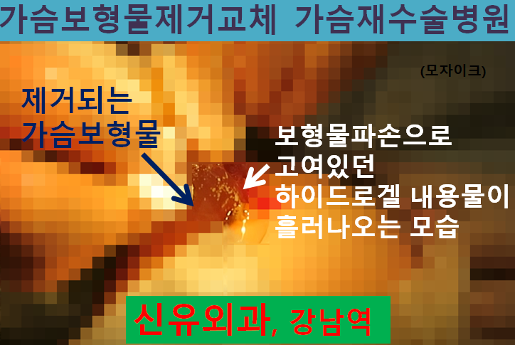 〔신유외과〕 20년전 수술한 가슴보형물파손(하이드로겔)으로 가슴보형물교체: 부분마취로 가슴재수술
