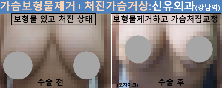 〔신유외과〕 완전파손된 가슴보형물 제거하면서 처진가슴 거상하기, 부분마취와 반달절개로.