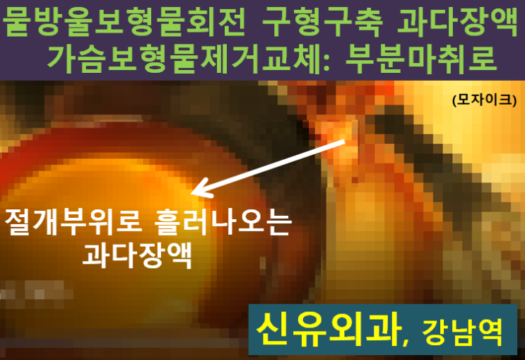 〔신유외과〕 구형구축있고 회전된 물방울가슴보형물제거교체: 부분마취로, 과다장액과 피막제거 같이