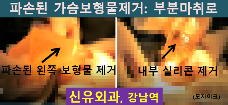 〔신유외과〕 보형물제거(물방울보형물파손,회전)+ 지방이식부작용치료: 구형구축치료 피막제거하면서