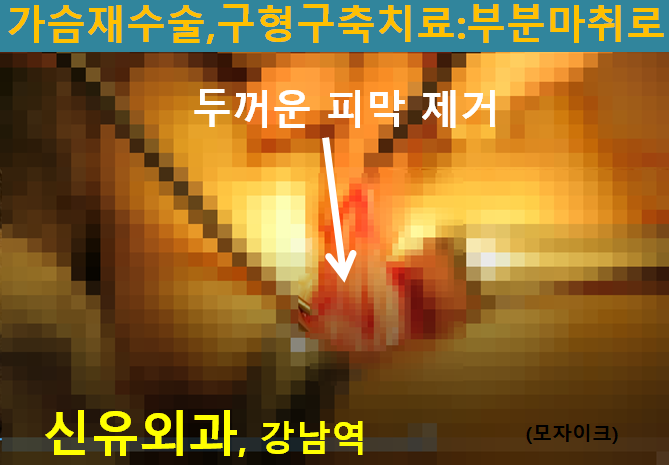 〔신유외과〕 가슴보형물교체(물방울보형물 비유착 회전, 과다장액,구형구축): 부분마취로