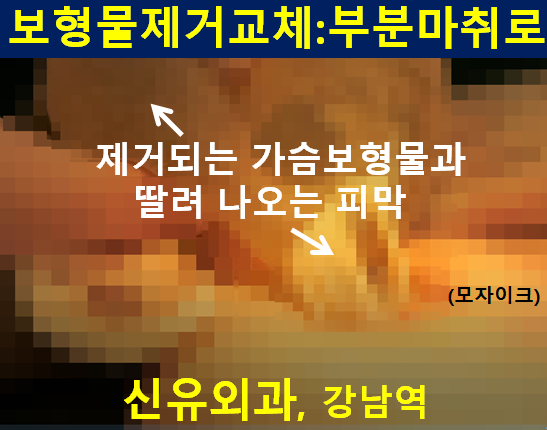 〔신유외과〕 가슴보형물제거:  250cc정도의 과다장액과 이중피막 제거하면서, 부분마취로