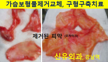 〔신유외과〕 가슴보형물제거(물방울보형물 비유착), 구형구축 피막제거, 장액제거: 부분마취로