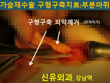 〔신유외과〕 구형구축 생긴지 오래된 가슴보형물교체하고 광범위 피막제거 (부분마취로)