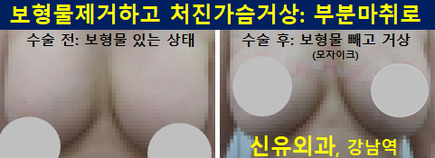 〔신유외과〕 보형물제거하며 처진가슴거상: 부분마취, 유륜반달절개로