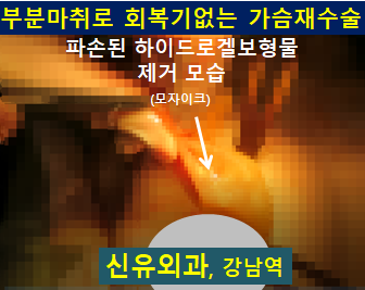 〔신유외과〕 하이드로겔보형물파손으로 가슴이 부어서 오신 분: 부분마취로 가슴보형물제거교체