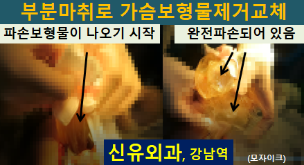 〔신유외과〕 완전파손된 가슴보형물제거교체, 방트기도 같이: 부분마취로