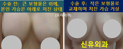 〔신유외과〕 파열된 보형물 교체+ 가슴거상: '가슴 네 개'상태. (가슴멍울맘모톰도 같이 진행함)