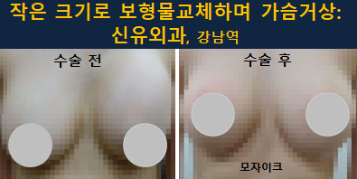 〔신유외과〕 가슴보형물교체+처진가슴거상: 구형구축과 피막손상, 근육손상과 과다장액