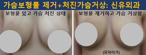 〔신유외과〕 처진가슴거상+보형물제거: 부분마취, 반달절개로