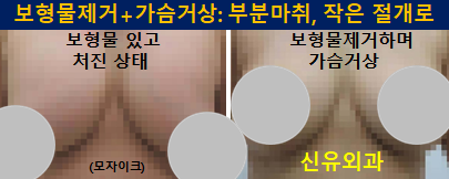 〔신유외과〕 보형물제거+가슴거상: 처진가슴교정과 볼륨확대효과