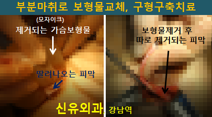 〔신유외과〕 단단해진 가슴보형물 교체: 피막제거하고 방트기까지, 부분마취로