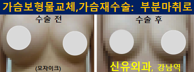 〔신유외과〕 보형물교체: 하이드로겔보형물파손으로 한쪽 가슴이 커져서 오신 분, 부분마취로 가슴재수술