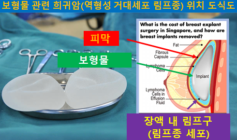 〔신유외과〕 앨러간(엘러간) 텍스쳐 보형물(바이오셀) 리콜: 희귀암(역형성 거대세포 림프종) 관련