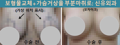 〔신유외과〕 처진가슴거상+보형물교체: 피막외 파손으로 림프절에 먹힌 실리콘과 이중피막도 같이 제거