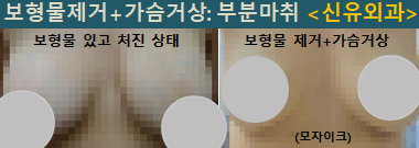 〔신유외과〕 오래된 식염수보형물 제거하며 처진가슴거상(슬라이딩방식, 윗볼륨 중점): 부분마취, 반달절개로