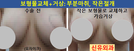 〔신유외과〕 보형물교체+가슴거상 (방찝기 같이): 부분마취, 반달절개