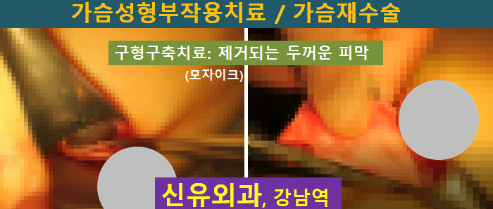 〔신유외과〕 보형물제거교체+피막제거: 물방울보형물 구형구축 (부분마취로)