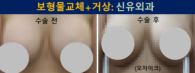 〔신유외과〕 구형구축 생기고 파손된 보형물 제거, 교체+처진가슴거상 (부분마취, 반달절개로)