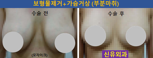 〔신유외과〕 너무 커서 불편한 가슴보형물제거, 피막제거하면서 처진가슴거상(부분마취, 반달절개)